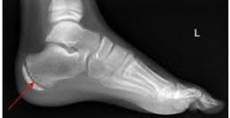 Calcaneal hot sale apophysitis treatment